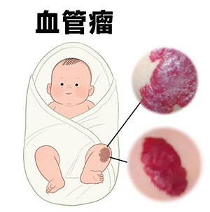 <strong>儿童血管瘤长什么样？初期图片参考</strong>