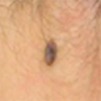 色素痣激光一次大概多少钱？南京胎记激光哪家好？