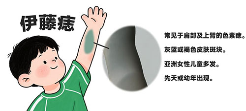 南京胎记医院哪家好点？伊藤痣怎么回事？