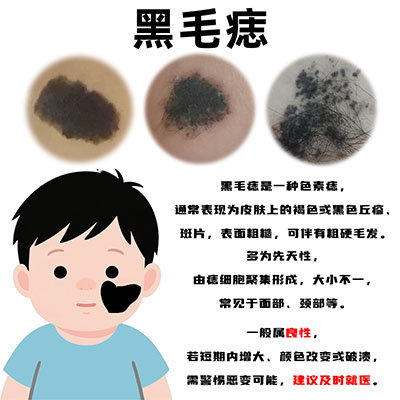 黑毛痣会带来的影响有什么？南京胎记医院哪里好？